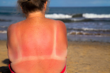 Mature woman in a bikini with sunburn on her shoulders 