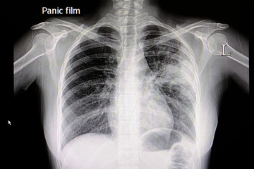 pneumonia chest film