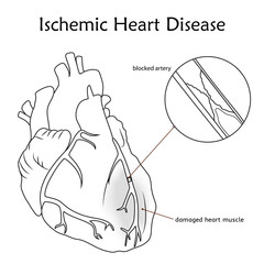 Ischemic Heart Disease. Blocked artery, damaged heart muscle. Anatomy flat illustration. Outline image, white background.