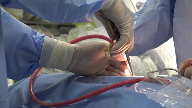 Spinal fusion, also called spondylodesis or spondylosyndesis, is a neurosurgical or orthopedic surgical technique that joins two or more vertebrae.
