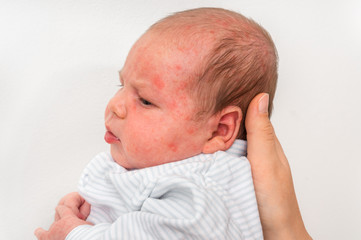 Newborn baby with skin rash. Allergic reaction after birth.