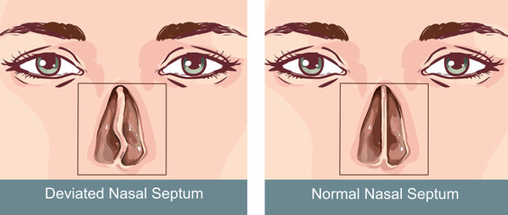 Nasal Septum Deviation Treatmen - obrazy, fototapety, plakaty