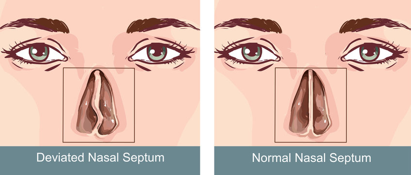 Nasal Septum Deviation Treatmen