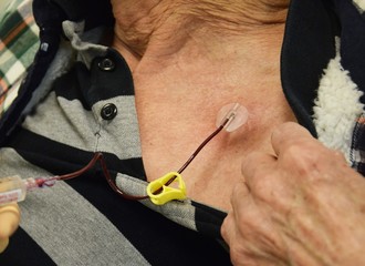 Blutabnahme vor einer Chemotherapie durch einen Port an der Brust eines alten Mannes