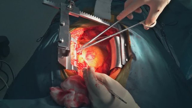 Surgeons team operating heart operating live shot