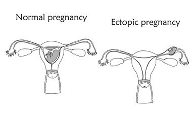 Ectopic and normal pregnancy. The fetus, uterus, womb. Anatomy thin line flat illustration. White background.