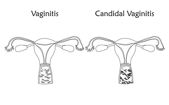 Vaginitis and candidal vaginitis. Human realistic uterus. Anatomy flat illustration. Thin line image, white background. Gynecological diseases.
