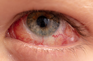 Red eye on face after surgery