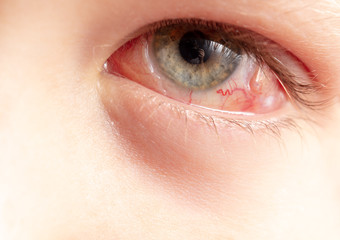 Obraz premium Red eye on face after surgery