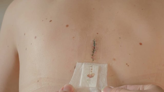 Peeling the patch on scar after removal of surgical sutures. Large nevus has been excised surgically with a scalpel. Preventive measure against skin cancer.