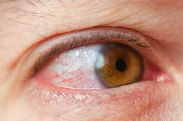 Closeup irritated infected red bloodshot eyes, conjunctivitis