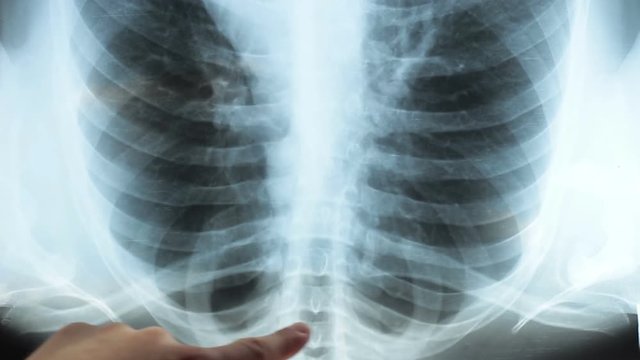 Doctor examining an x-ray of a patient's lungs. Healthy easy men in the picture