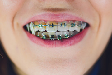 Teeth with dental braces and elastics full mouth. Teeth whitening by the dentist. half teeth dirty half clean.