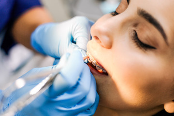 Dentist putting braces on the patient's teeth close-up in a dental clinic