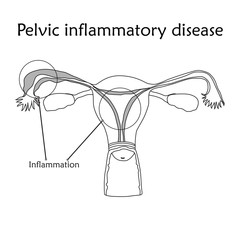 Pelvic inflammatory disease. Human realistic uterus. Anatomy flat illustration with specification. Thin line image, white background. Gynecological diseases.