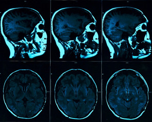 Magnetic resonance scan of the brain with skull. MRI head scan on dark background blue color. X-ray medicine and medication concept