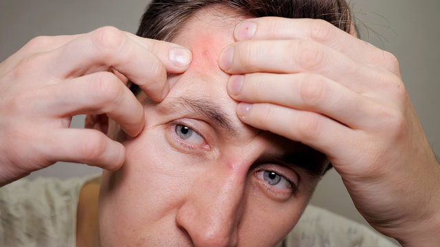 Close up photo of young man looking for acnes on his face.