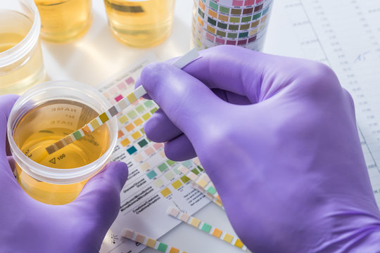 urine test strips in purple gloves
