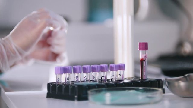 Medical clinic. A blood test. A nurse takes the blood from the vitro