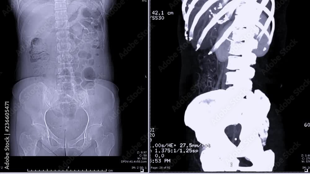 Poster ct scan of urinary system or ct urography comparison 2d and 3d rendering image.