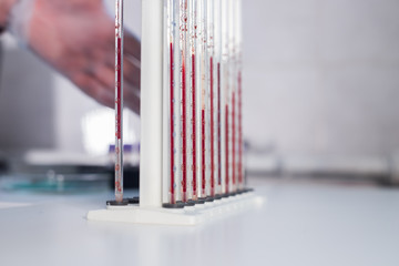 Medical clinic. A stand with pipettes filled with different blood.