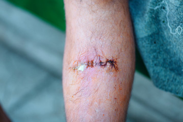 the stitched wound on a male leg