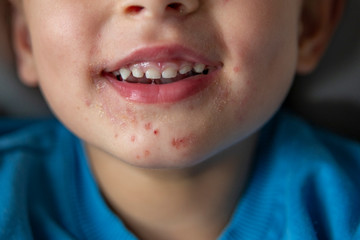 Hand, foot, and mouth disease (HFMD). Typical lesions around the mouth