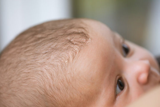 Seborrheic dermatitis on head in asian baby