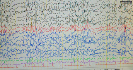 Computer monitor showing electrical activity of abnormal brain,EEG of the pediatric patients with problems in the brain.