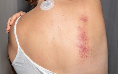 Bruise. Woman. Back. Medical. Treatment. Pain