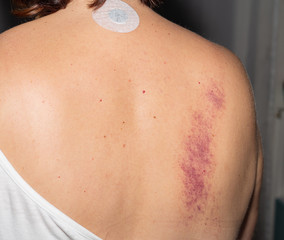 Bruise. Woman. Back. Pain. Medical. Treatment