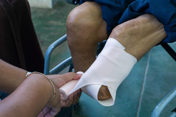 elastic bandaging of below knee amputation