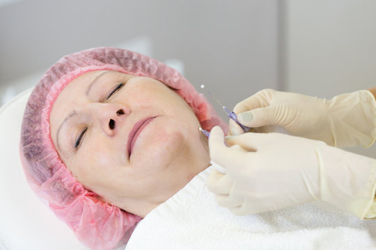 Close-up of procedure for face lifting PDO Suture operation, face lifting surgery. innovative technique of New thread lift, NovaThreads and Silhouette InstaLift