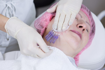Aged woman doing mesothreads and Thread Lifting, Cosmetology. Cosmetic procedure to eliminate signs...