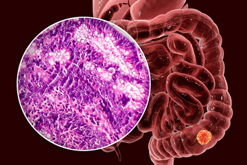Colon cancer, 3D illustration and photo under microscope. Light micrograph showing colon adenocarcinoma