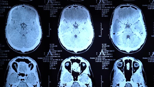 X-ray of the brain in backlight in the operating room. Skull.