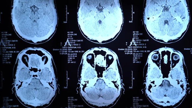 X-ray of the brain in backlight in the operating room. Skull.