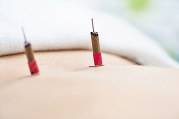 Woman being treated with acupuncture and moxibustion treatments