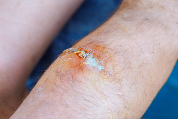 peroxide foams on the wound