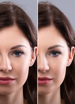 Woman's Face Before And After Cosmetic Procedure