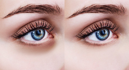 Female eyes with bruises under eyes before and after treatment.