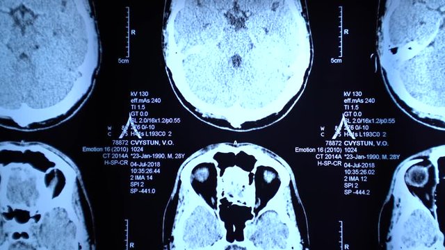 X-ray of the brain in backlight in the operating room. Skull.