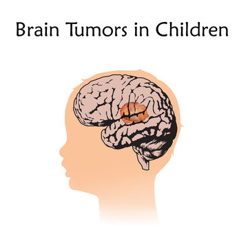 Brain Tumors, Cancer In Infants, Childhood. Vector Medical Illustration. Kid, Baby, Childhood. White Background, Silhouette Of Child Head, Anatomy Flat Image.