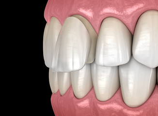 Dental Veneer: Central incisor Veneer installation Procedure. Medically accurate tooth 3D illustration