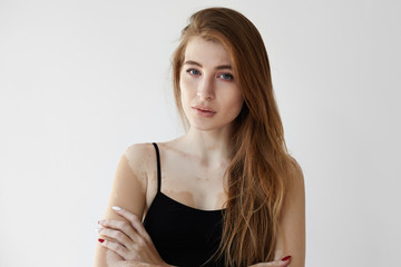 Portrait of beautiful confident young European woman with vitiligo posing in studio, dressed in black tank top, looking at camera with serious facial expression. Skin disorder, health and illness