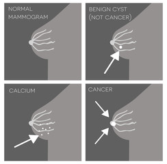 Different screening results of woman mammogram poster