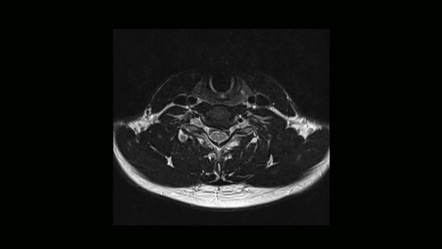 Computed medical tomography MRI scan of the cervical spine of a man with osteochondrosis