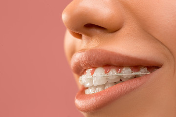 Beautiful young woman with teeth braces - obrazy, fototapety, plakaty