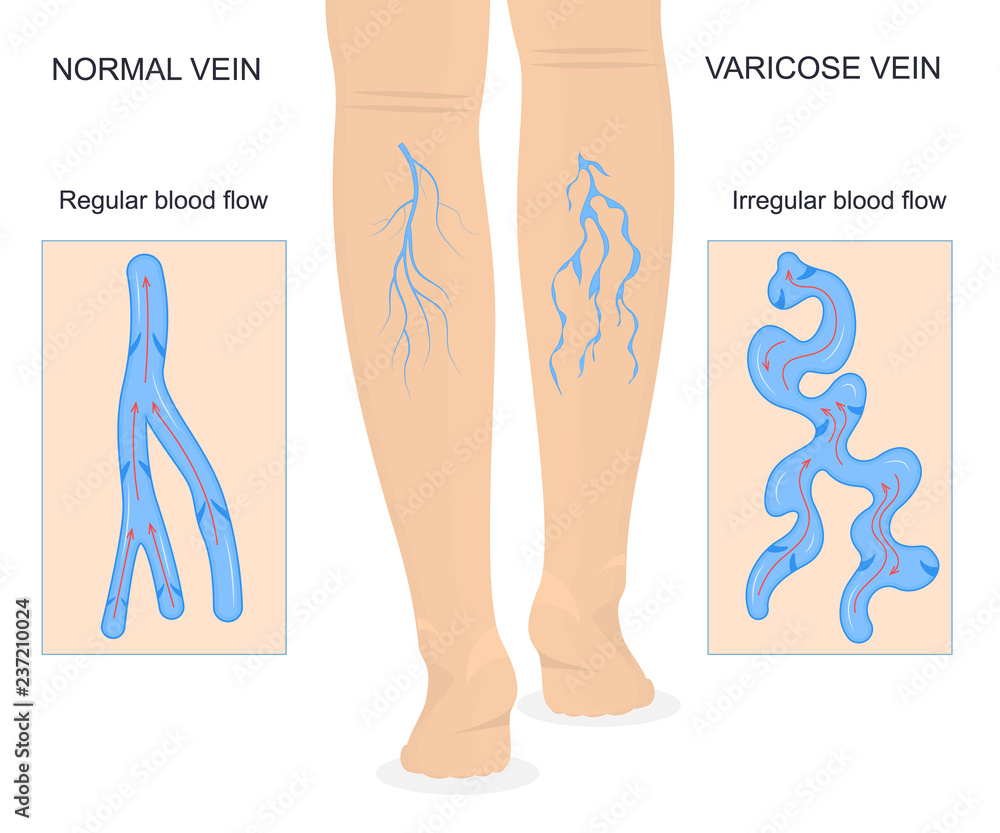 Poster Varicose Veins Concept Banner Card with Elements. Vector