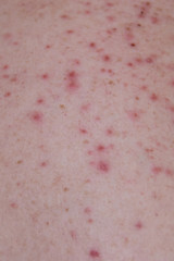 Fototapeta premium Problem skin. Acne on the skin. Texture of oily problem skin
